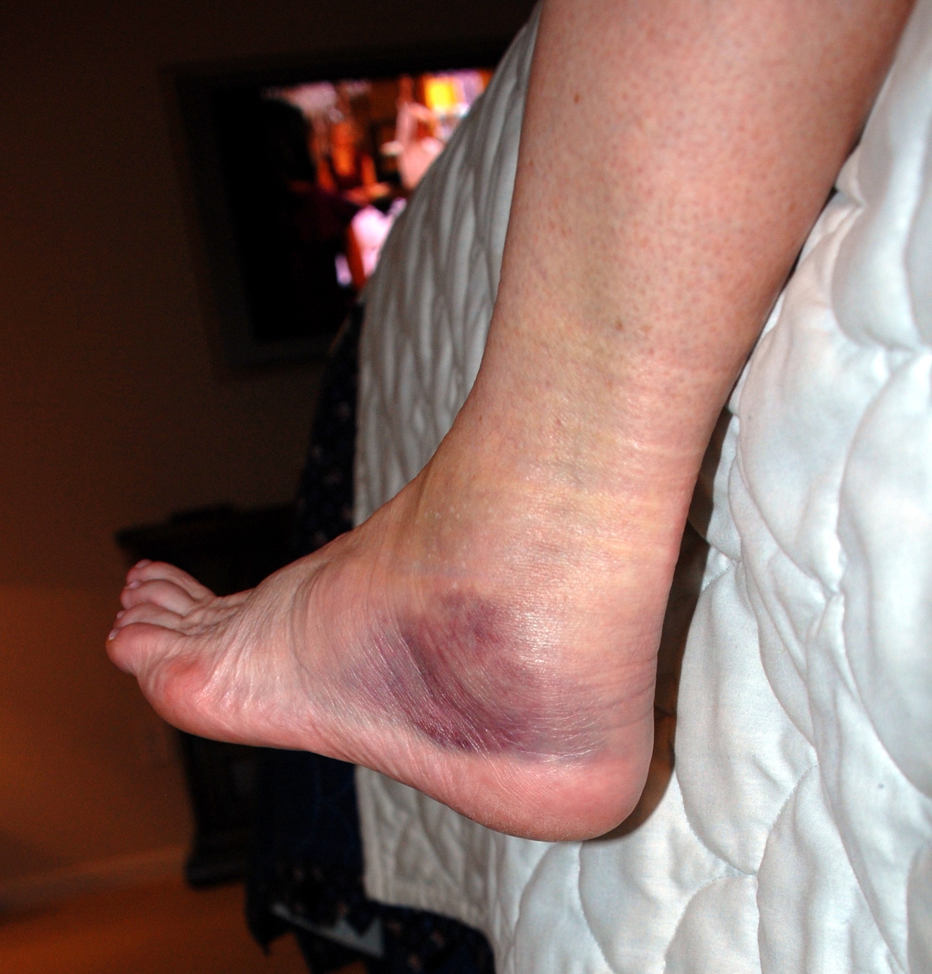 2009-02-08-01 SPRAINED ANKLE.jpg